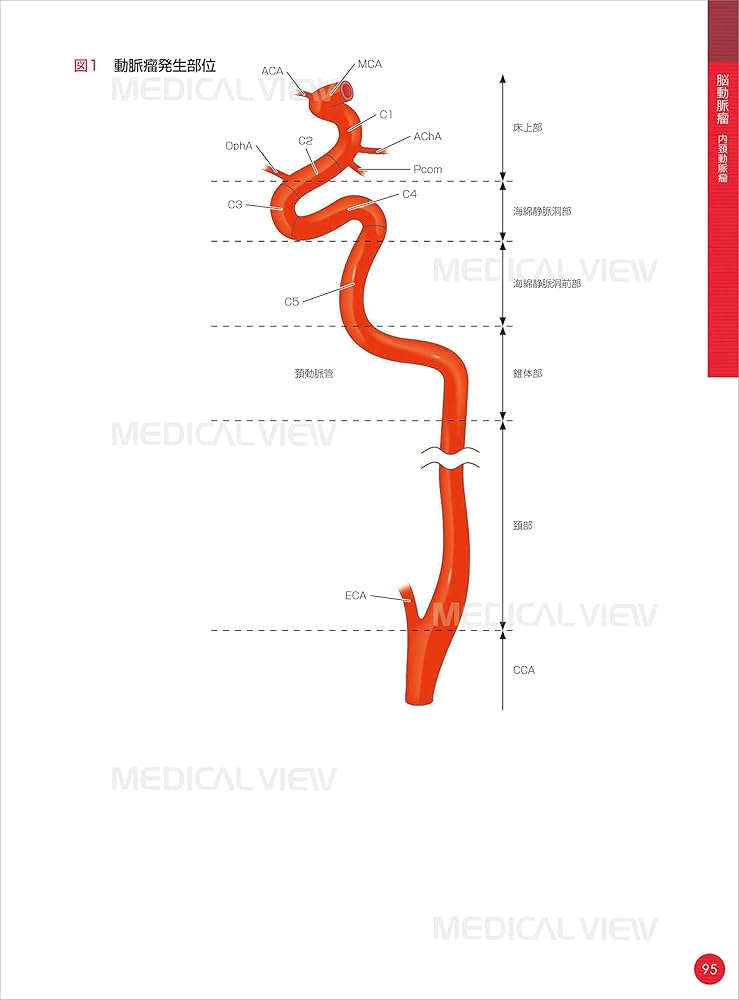 Amazon.co.jp: 脳血管内治療 スタート&スタンダード : 吉村 紳一